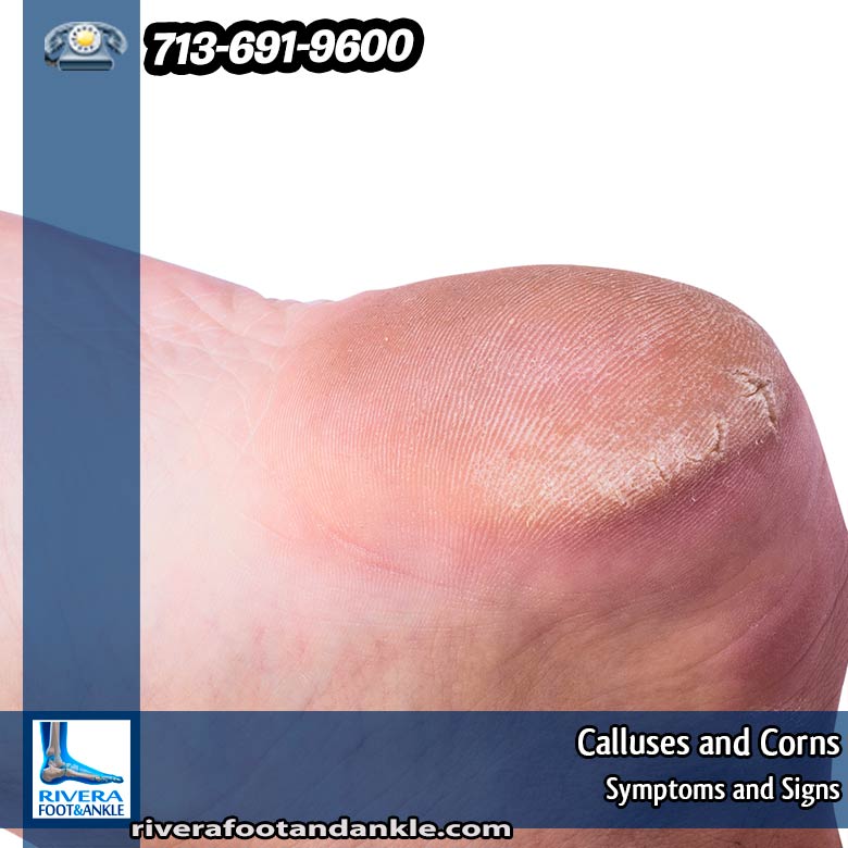 Rivera Foot And Ankle Calluses And Corns