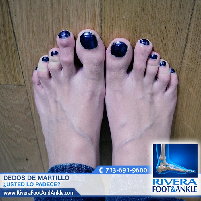 250916 deformidades en los pies doctor