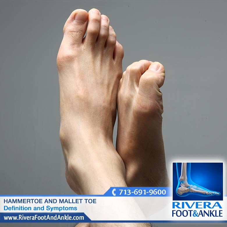 Rivera Foot and Ankle Hammertoe and Mallet Toe