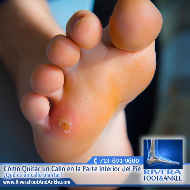 Como curar uña encarnada y quitar los callos de los pies - Centro Médico El  Pilar