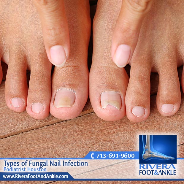 Vedobi - What is Nail Fungal Infection? Know its Types, Causes and Treatment
