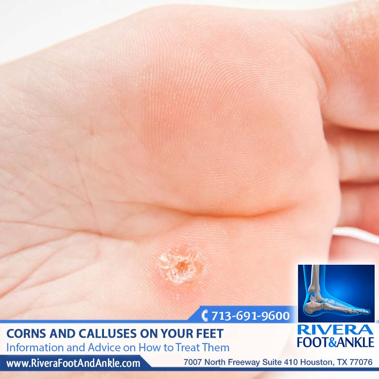 270118 Corns and Calluses Doctor in Houston