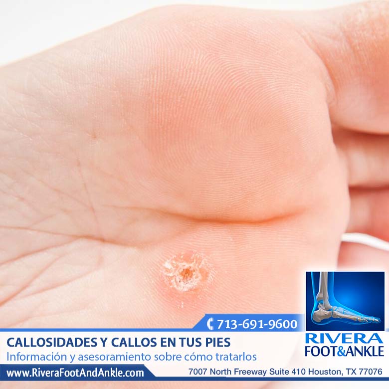 280118 Callosidades en los pies