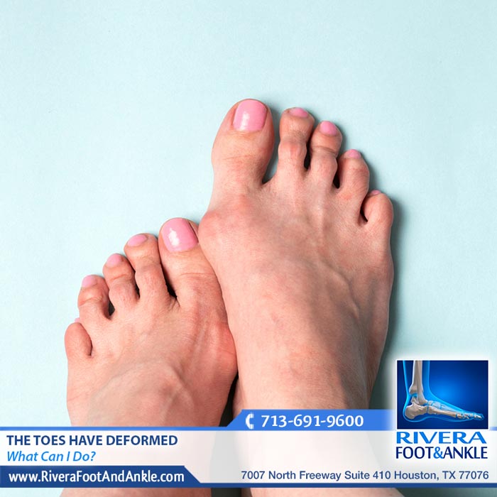 130318 Toes deformed specialist in Houston