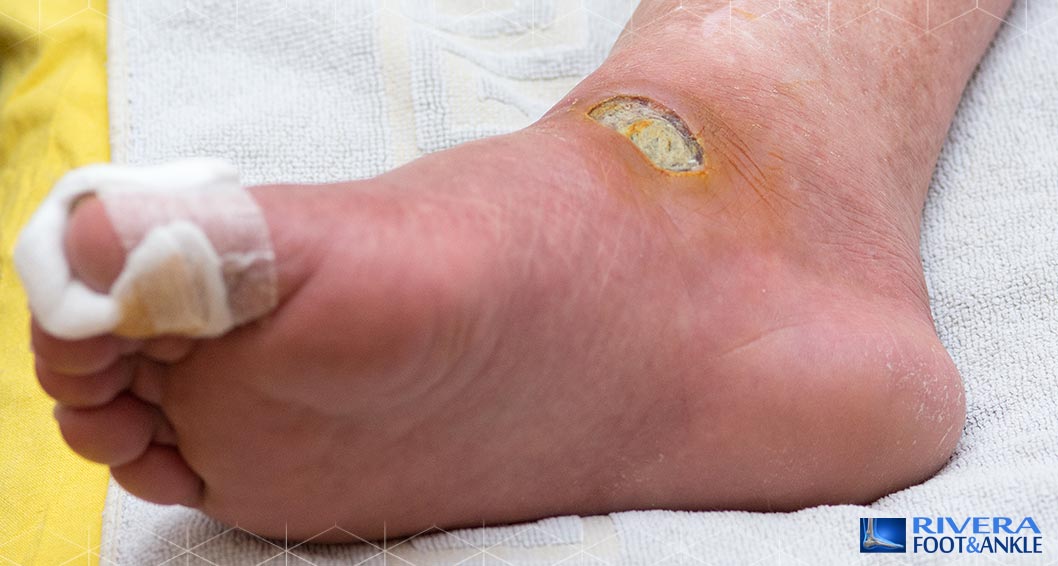 16 Diabetic Foot