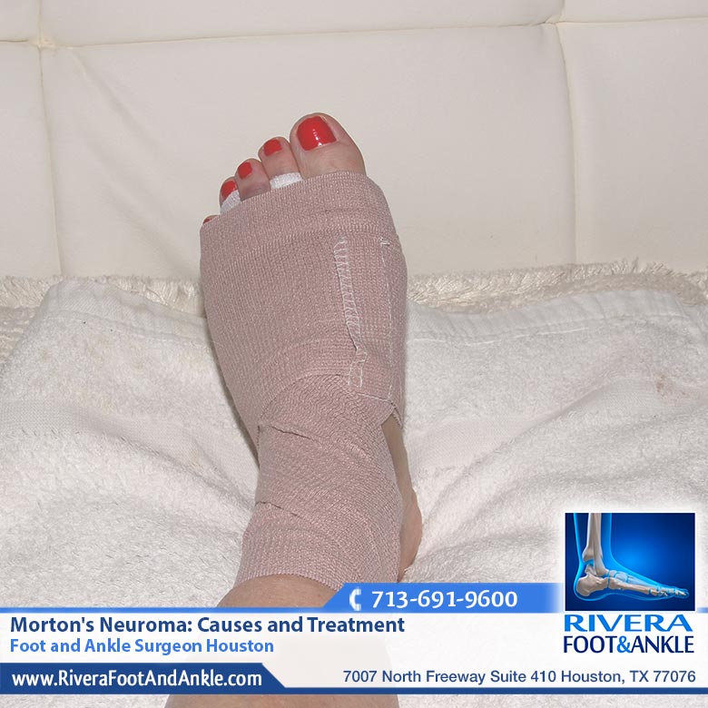 26 Mortons Neuroma