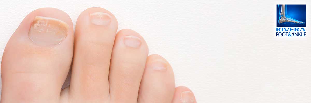 How Do You Get Rid Of Dark Spots On The Toes? – My FootDr