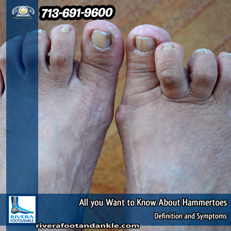 07-all-you-want-know-about-hammertoes