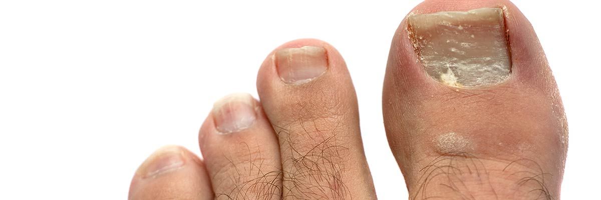 Rivera Foot and Ankle - Yellow and Cracked Toenails: Causes