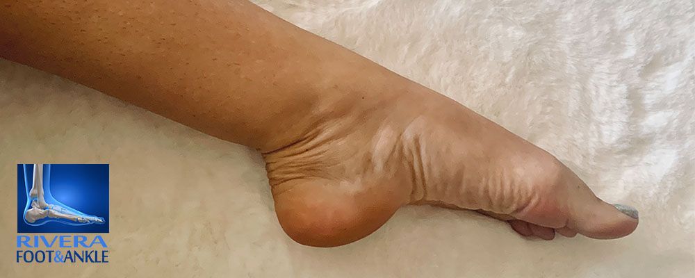 Rivera Foot and Ankle - ¿Cómo puedo cuidar de una uña encarnada?